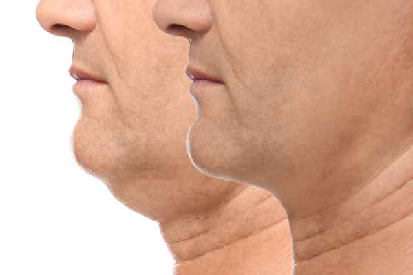 HIFU - Breakthrough in Anti - ageing 2 hifu results Buxton