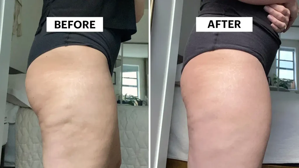 Do Toning Exercise Buxton Really Tackle Cellulite?