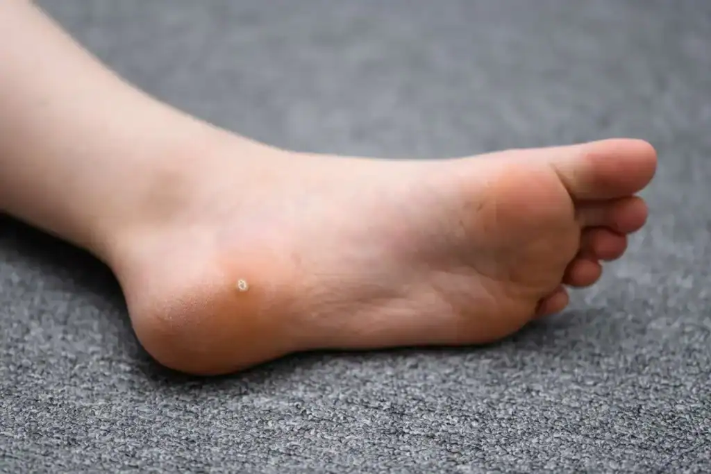 Cryotherapy For Warts And Also Verrucas 2 Image of verruca on the bottom of the foot that able to be treated with Cryotherapy Buxton