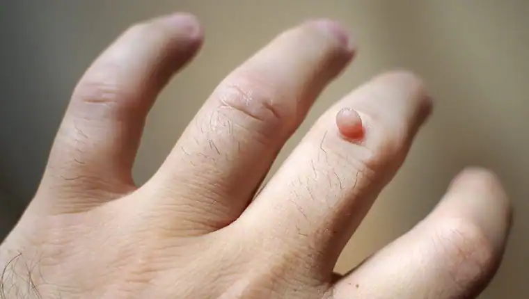 Cryotherapy For Warts And Also Verrucas 1 Image of blemish that Cryotherapy Buxton can remove with Lipo 360.