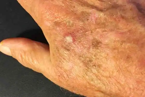 Image of Actinic keratoses Buxton on a person hand