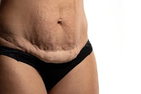 The science behind skin tightening Buxton picture of a woman's sagging skin on the stomach